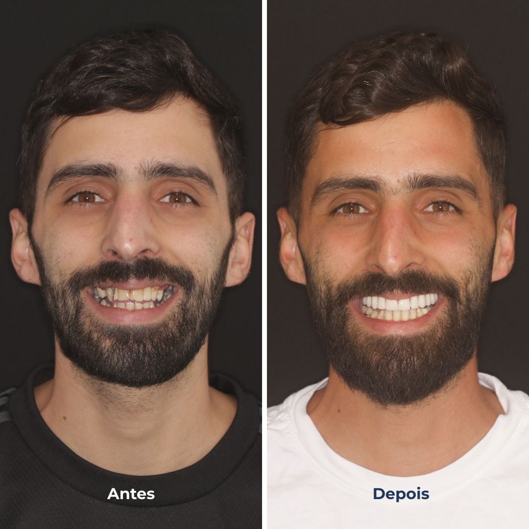 prótese fixa