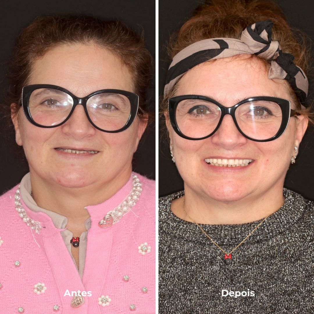 prótese fixa sobre implantes