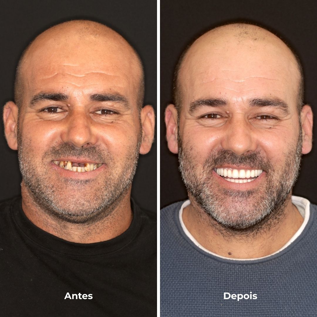 prótese fixa sobre implantes