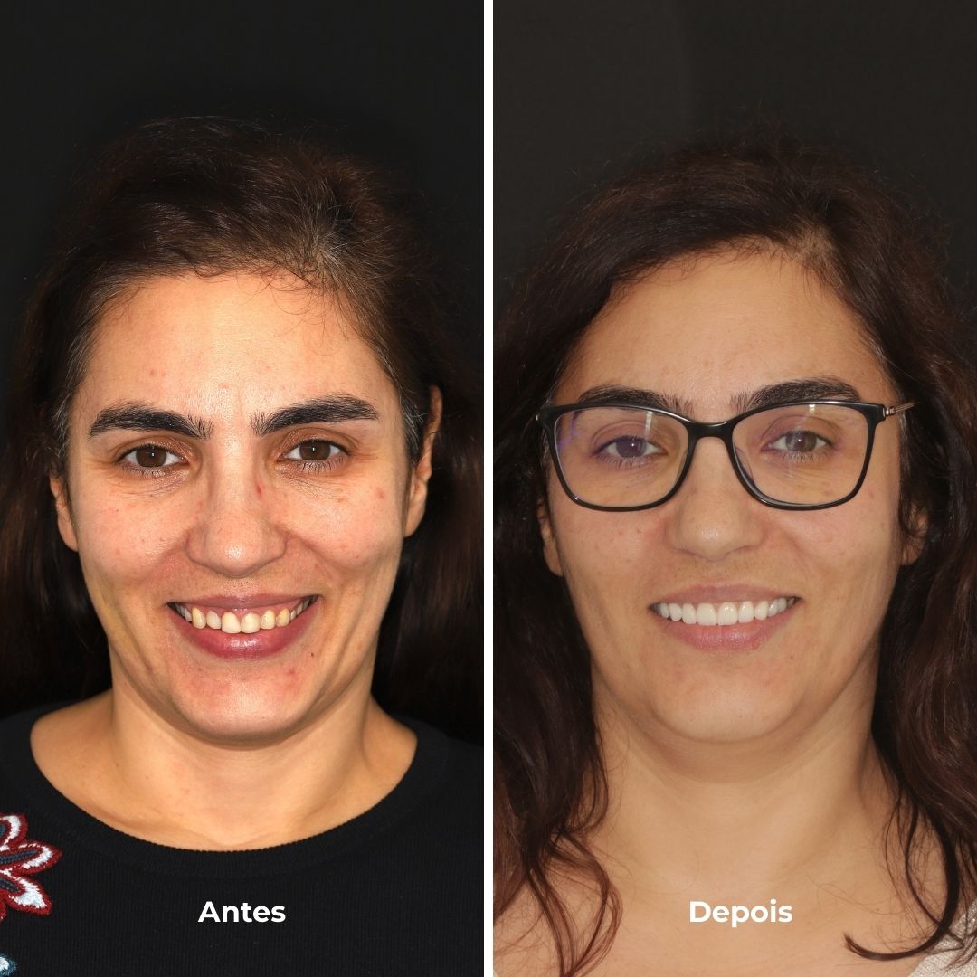 facetas dentárias